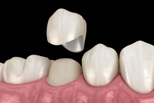 Dental Crowns: Common Issues And How To Address Them