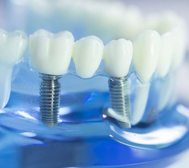 Selma Dental Implants
