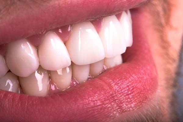 Dental Fillings: A Dental Restoration To Treat Cavities