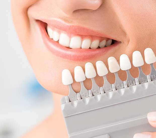 Selma Dental Veneers and Dental Laminates