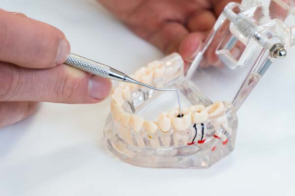 Tips To Prepare For Root Canal Treatment